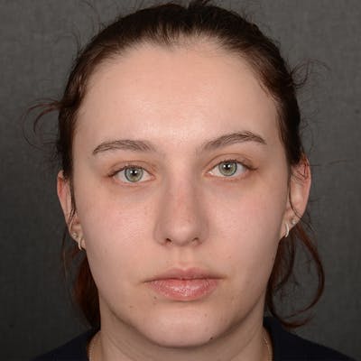 Chin Augmentation Before & After Gallery - Patient 939650 - Image 2
