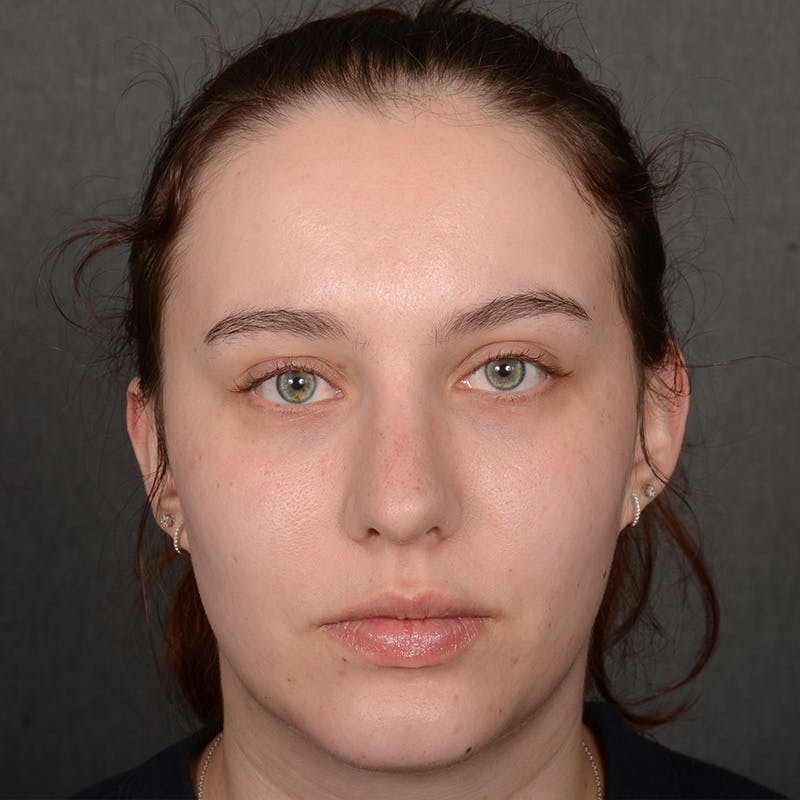 Chin Augmentation Before & After Gallery - Patient 939650 - Image 2
