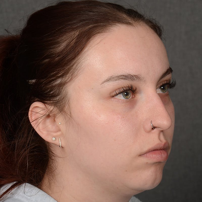 Chin Augmentation Before & After Gallery - Patient 939650 - Image 3