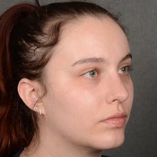 Chin Augmentation Before & After Gallery - Patient 939650 - Image 4