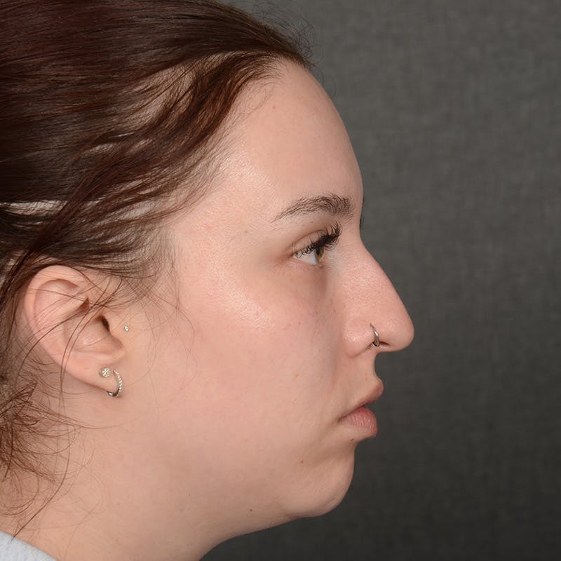 Chin Augmentation Before & After Gallery - Patient 939650 - Image 5