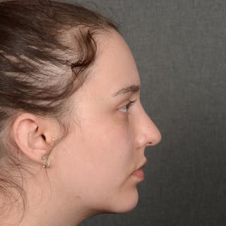 Chin Augmentation Before & After Gallery - Patient 939650 - Image 6