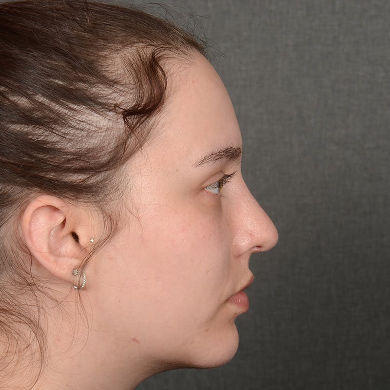 Chin Augmentation Before & After Gallery - Patient 939650 - Image 6