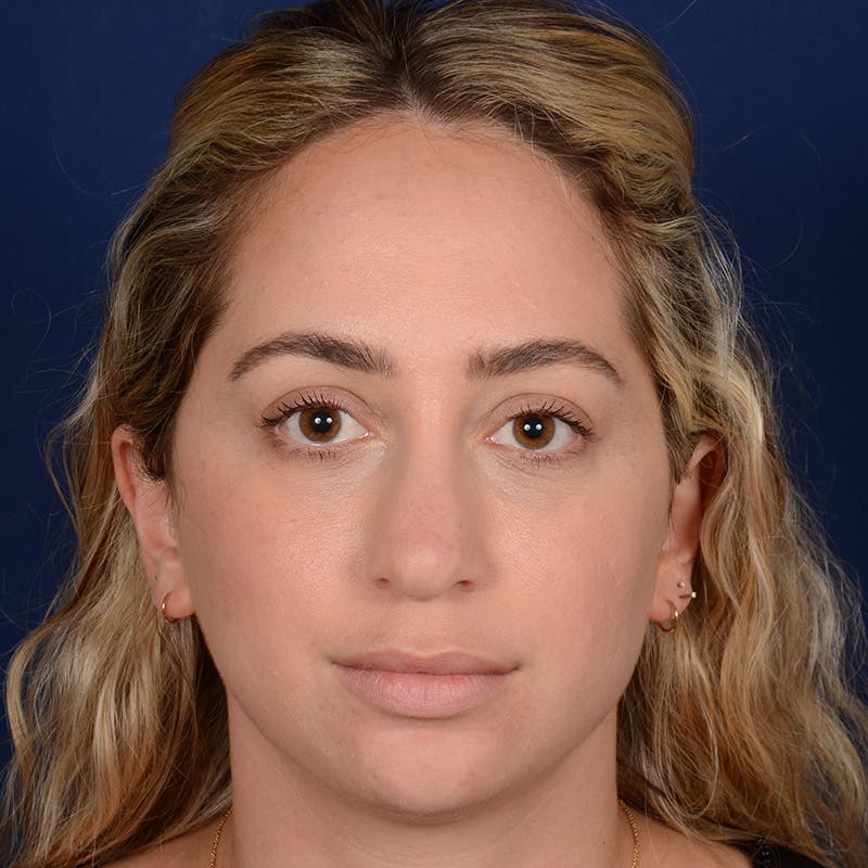 Chin Augmentation Before & After Gallery - Patient 186622 - Image 1