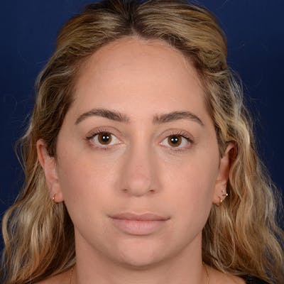Chin Augmentation Before & After Gallery - Patient 186622 - Image 1