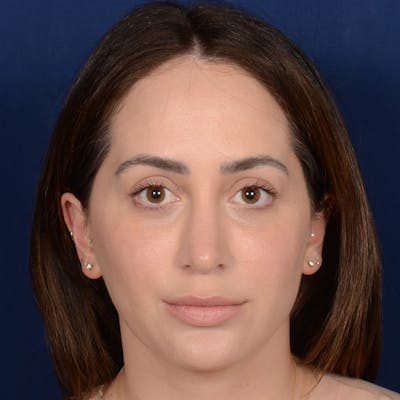 Chin Augmentation Before & After Gallery - Patient 186622 - Image 2