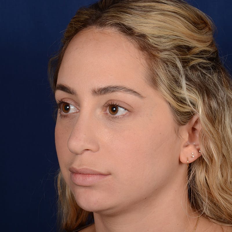Chin Augmentation Before & After Gallery - Patient 186622 - Image 3