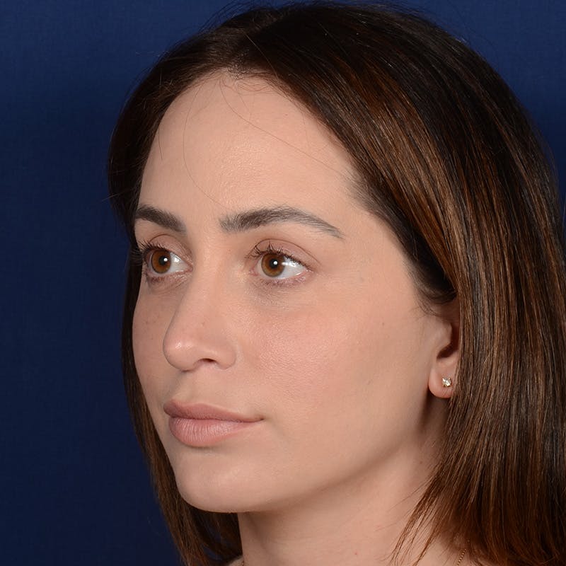 Chin Augmentation Before & After Gallery - Patient 186622 - Image 4
