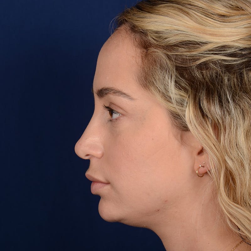 Chin Augmentation Before & After Gallery - Patient 186622 - Image 5