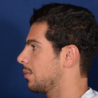 Chin Augmentation Before & After Gallery - Patient 188951 - Image 6