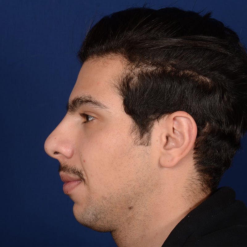 Chin Augmentation Before & After Gallery - Patient 188951 - Image 5