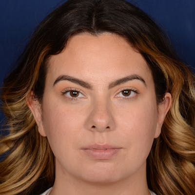 Chin Augmentation Before & After Gallery - Patient 203393 - Image 1