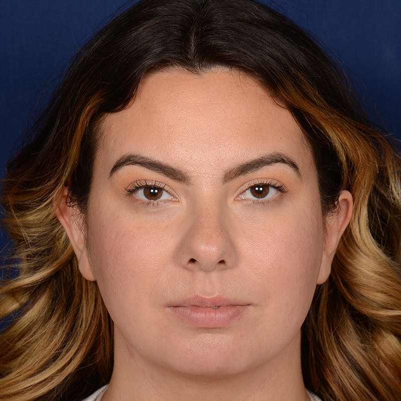 Chin Augmentation Before & After Gallery - Patient 203393 - Image 1