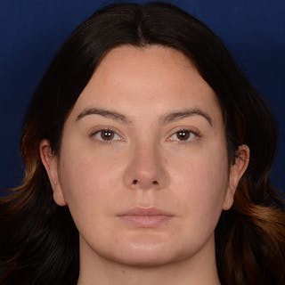 Chin Augmentation Before & After Gallery - Patient 203393 - Image 2