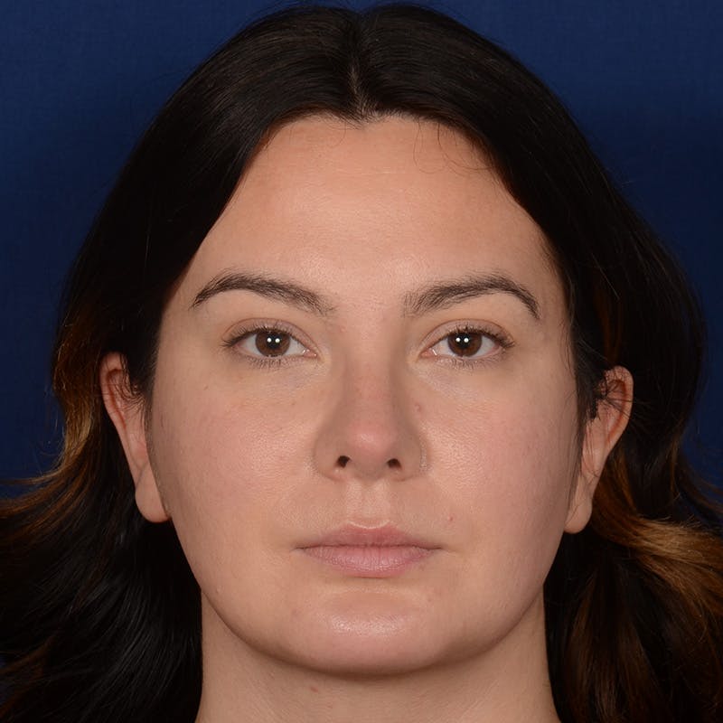 Chin Augmentation Before & After Gallery - Patient 203393 - Image 2