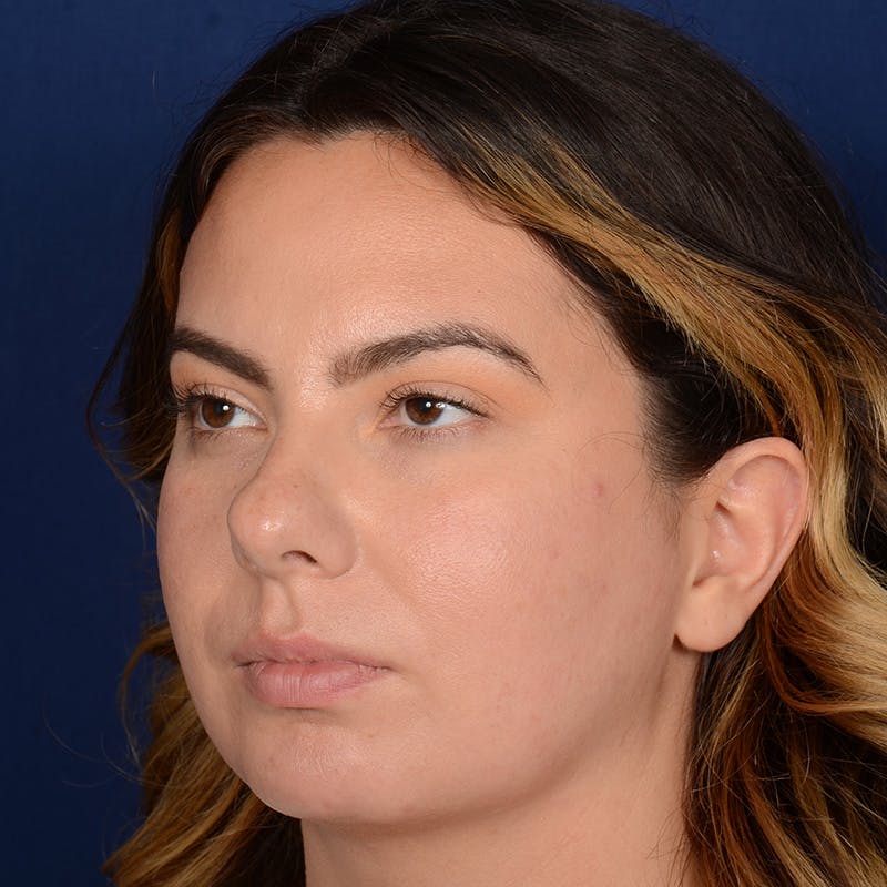Chin Augmentation Before & After Gallery - Patient 203393 - Image 3