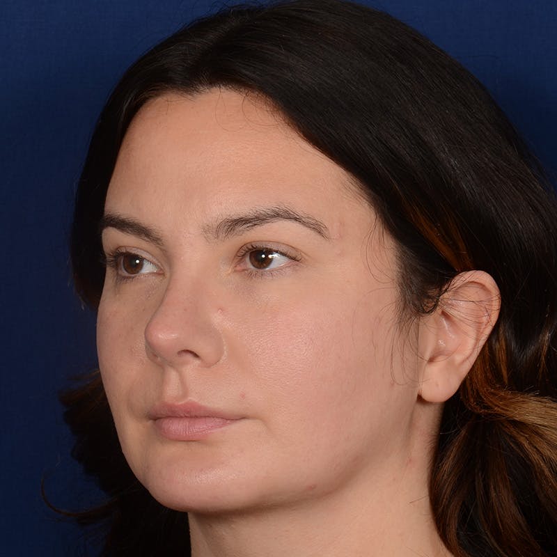 Chin Augmentation Before & After Gallery - Patient 203393 - Image 4