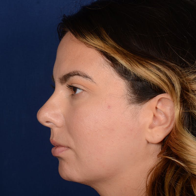 Chin Augmentation Before & After Gallery - Patient 203393 - Image 5