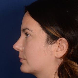 Chin Augmentation Before & After Gallery - Patient 203393 - Image 6