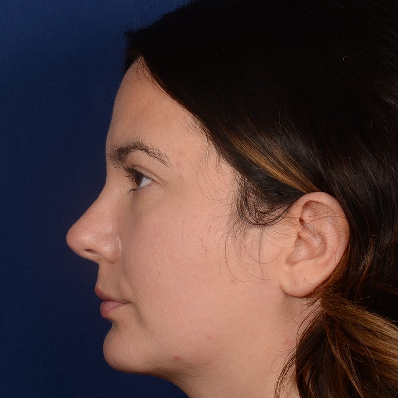 Chin Augmentation Before & After Gallery - Patient 203393 - Image 6