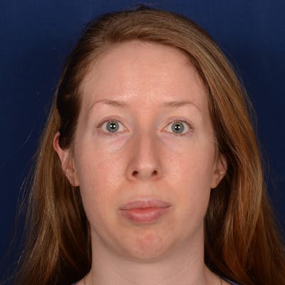 Chin Augmentation Before & After Gallery - Patient 360898 - Image 1
