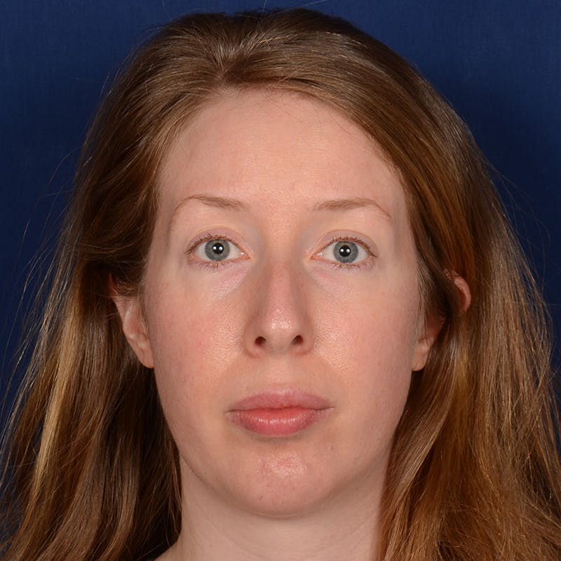 Chin Augmentation Before & After Gallery - Patient 360898 - Image 2