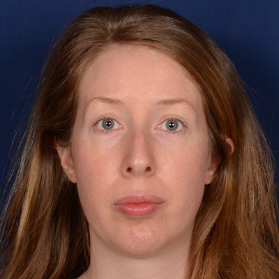 Chin Augmentation Before & After Gallery - Patient 360898 - Image 2