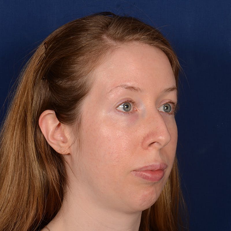 Chin Augmentation Before & After Gallery - Patient 360898 - Image 3