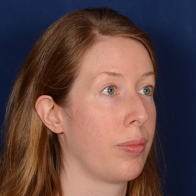 Chin Augmentation Before & After Gallery - Patient 360898 - Image 4