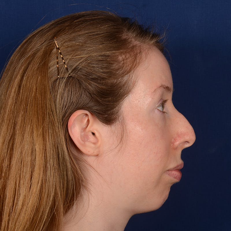 Chin Augmentation Before & After Gallery - Patient 360898 - Image 5