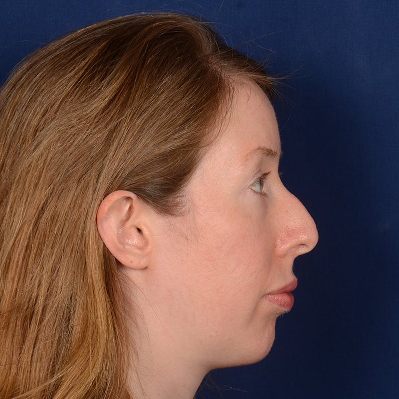 Chin Augmentation Before & After Gallery - Patient 360898 - Image 6