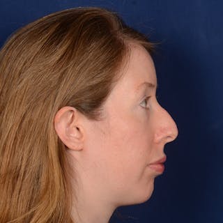 Chin Augmentation Before & After Gallery - Patient 360898 - Image 6