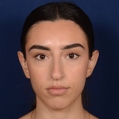 Chin Augmentation Before & After Gallery - Patient 164600 - Image 1