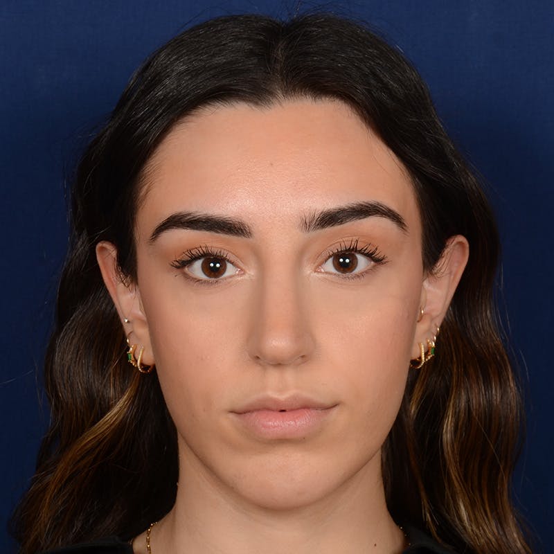Chin Augmentation Before & After Gallery - Patient 164600 - Image 2