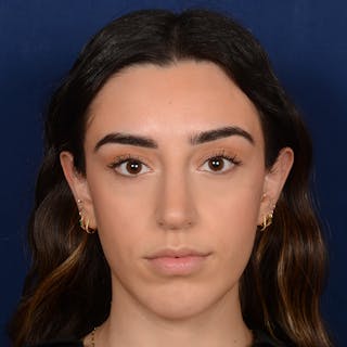 Chin Augmentation Before & After Gallery - Patient 164600 - Image 2