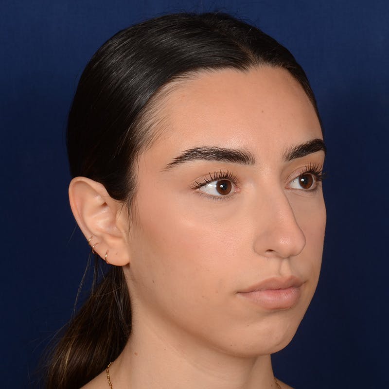 Chin Augmentation Before & After Gallery - Patient 164600 - Image 3