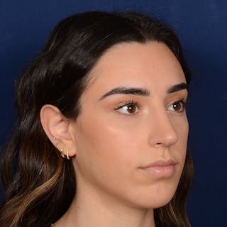 Chin Augmentation Before & After Gallery - Patient 164600 - Image 4