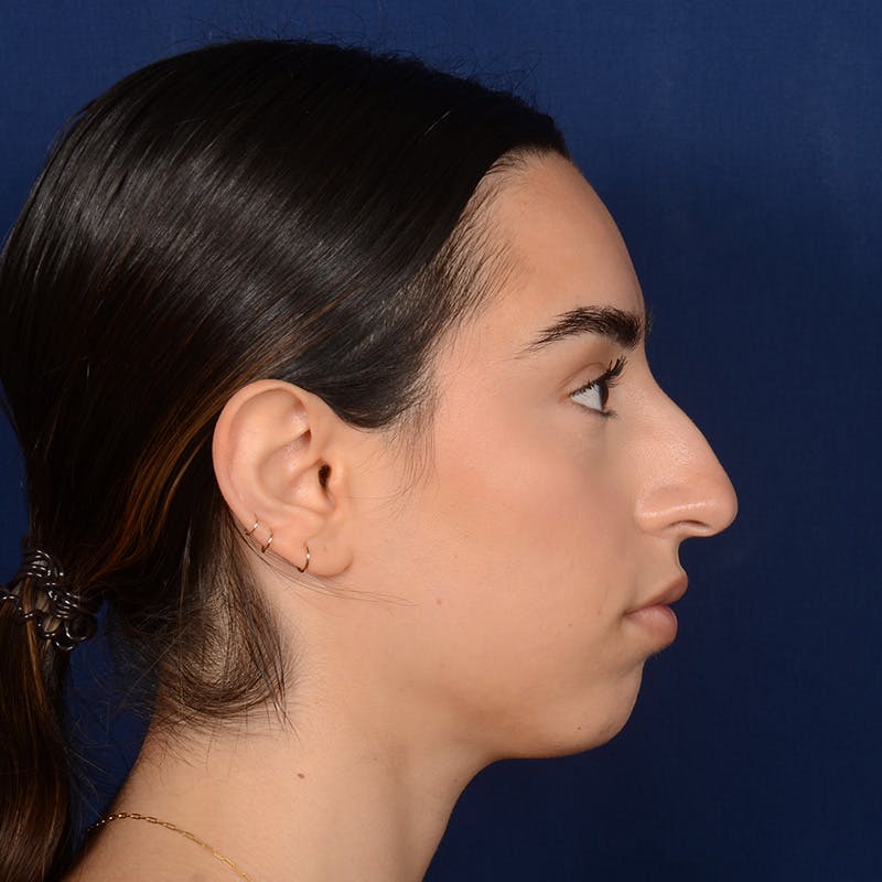 Chin Augmentation Before & After Gallery - Patient 164600 - Image 5