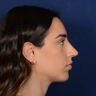 Chin Augmentation Before & After Gallery - Patient 164600 - Image 6