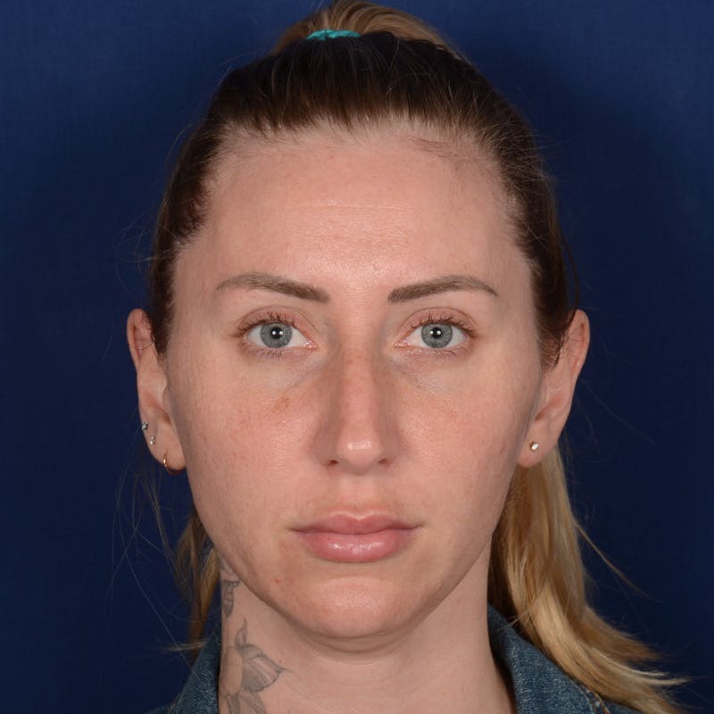 Chin Augmentation Before & After Gallery - Patient 403251 - Image 1