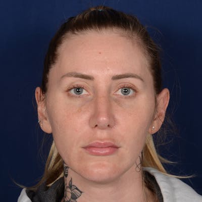 Chin Augmentation Before & After Gallery - Patient 403251 - Image 2