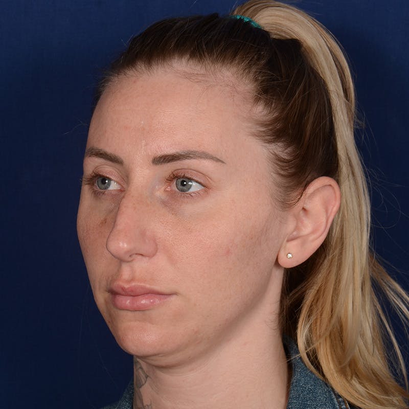Chin Augmentation Before & After Gallery - Patient 403251 - Image 3