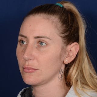 Chin Augmentation Before & After Gallery - Patient 403251 - Image 4