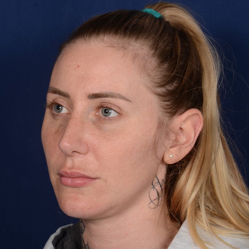 Chin Augmentation Before & After Gallery - Patient 403251 - Image 4