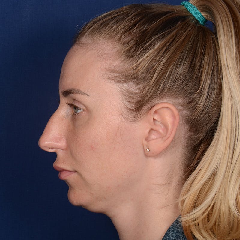 Chin Augmentation Before & After Gallery - Patient 403251 - Image 5