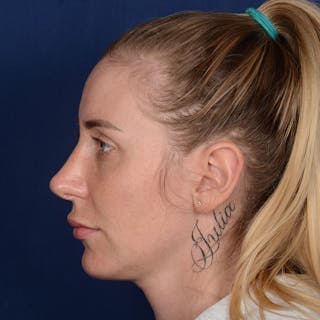 Chin Augmentation Before & After Gallery - Patient 403251 - Image 6