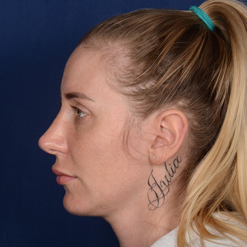 Chin Augmentation Before & After Gallery - Patient 403251 - Image 6