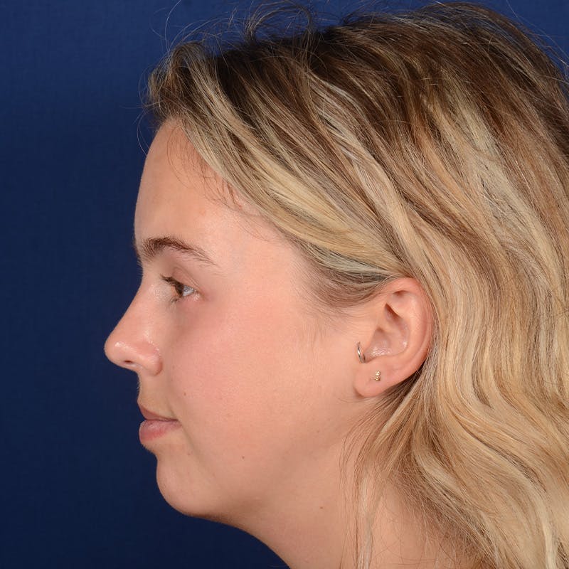 Chin Augmentation Before & After Gallery - Patient 188085 - Image 5