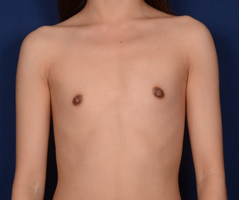 Breast Augmentation Before & After Gallery - Patient 396236 - Image 1