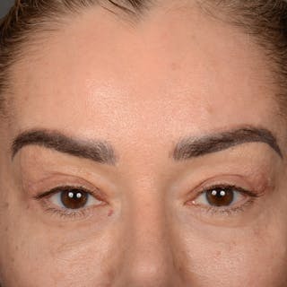 Eyelid Surgery Before & After Gallery - Patient 211894 - Image 2